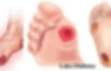 Jadi Penyakit Mengerikan, Penderita Diabetes Harus Waspada dengan Kondisi Kaki Mereka