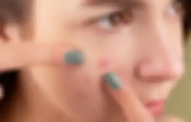 Tips Hidup Bagi Pejuang Acne! Kenali 3 Faktor Penyebab Jerawat yang Diungkap Langsung Oleh Dokter Kecantikan