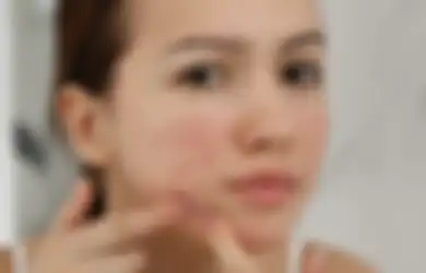 Pejuang Jerawat Harus Tahu! Hindari Skincare dengan Kandungan Ini Jika Tidak Ingin Masalah Meradang