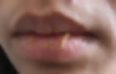 Selain Dehidrasi, Ini 9 Hal yang Bisa Menyebabkan Bibir Pecah-pecah