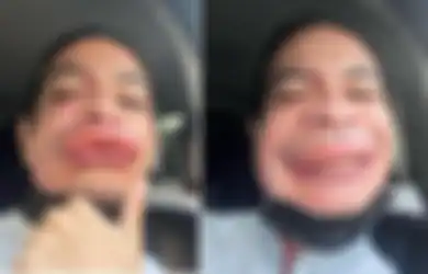 Selesai Mandi Tak Sadar Ada Serangga Hinggap di Handuknya, Aktor Ini Syok Mendapati Bibirnya Langsung Bengkak Akibat Tersengat Tawon, Bukannya Malu Malah Pamer di Sosmed