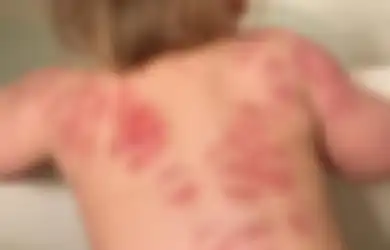 Syok Tahu Kondisi Punggung Bayinya Usai Pulang Dari Tempat Penitipan Anak, Ibu Ini Curigai Hal Ini Jadi Pemicunya hingga Membuatnya Murka