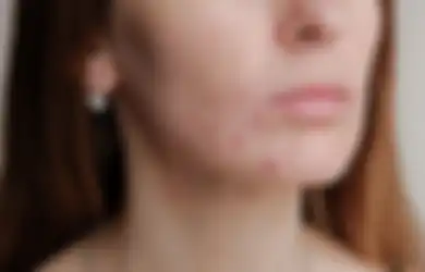 Bikin Flawless, Ini 3 Manfaaat Vitamin C Buat Kulit Berjerawat
