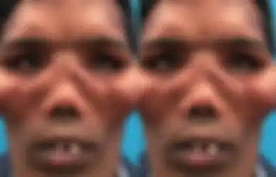 20 Tahun Hidup Dengan Wajah Tak Lazim, Pria Ini Buat Semua Orang Melongo Setelah Dokter Lakukan Ini Pada Wajahnya