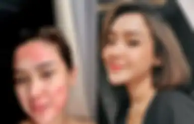 Niat Hati Tampil Cantik dengan Suntik Putih, Pedangdut Cantik Ini Malah Kena Penyakit Langka, Sekujur Wajahnya Dipenuhi Bercak Merah