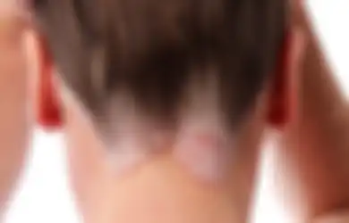 Hati-Hati, Covid-19 Lebih Berisiko Berbahaya pada Pasien Psoriasis