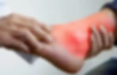 Jangan Mau Kena Risiko Penyakit Tambahan Karna Sering Minum Obat, Ramuan Bahan Alami ini Ampuh Obati Asam Urat dalam Sekejap