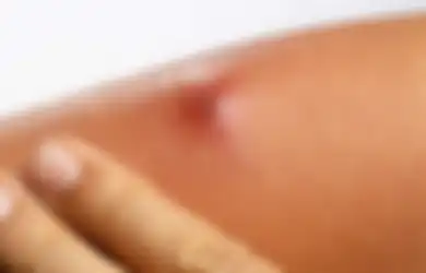 Tips Hidup Cara Obati Bisul Agar Cepat Kempes, Bisa Dilakukan di Rumah dan Cukup Gunakan Bahan Alami Ini