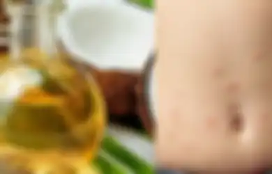 Muncul Jerawat di Area Perut? Simak Berikut Penyebab hingga Cara Mengatasinya dengan Bahan-bahan Alami yang Ada di Rumah Ini, Dijamin Berhasil!