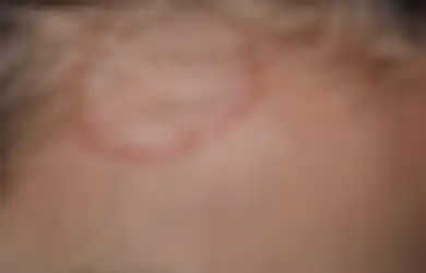 Tips Hidup Atasi Kurap, Berikut Ini Deretan Obat Alami yang Bisa Dicoba di Rumah