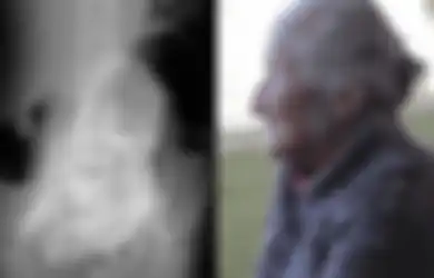 Hidup Dengan Janin Mati dalam Rahim Selama 60 Tahun, Nenek Tua Ini Ungkap Penderitaannya, Kondisinya Buat Dokter Merinding!