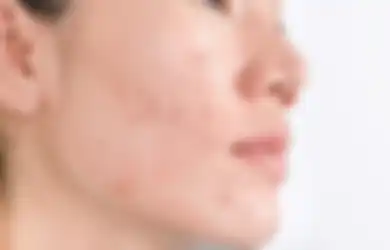 Jerawat Bikin Kamu Insecure? Jangan Panik, 6 Langkah Ini Bisa Jadi Solusi Wajah Kembali Sehat