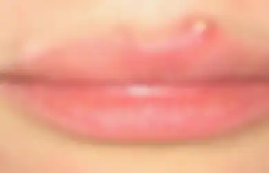 Ada Jerawat Di Bibir? Begini 5 Mudah Cara Menghilangkannya, Perhatikan
