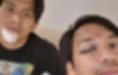 Wujud Profesionalitas dMasiv, Nekat Manggung Meski Mata Bengkak Membiru hingga Dagu Dijahit Usai Alami Kecelakaan Hebat, sang Vokalis Beberkan Alasannya