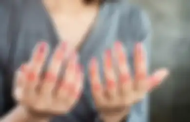 Jangan Diabaikan, 5 Hal Ini Diam-Diam Bisa Jadi Gejala Lupus!