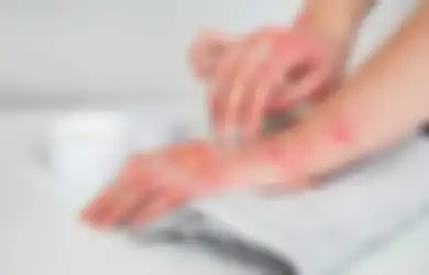 Nggak Perlu Rogoh Duit Banyak-banyak, Ternyata Obat Gatal Bisa dari Ramuan Bahan Alami dari Kunyit ini, Ampuh Hilangkan Penyakit Kulit