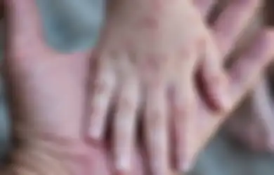 WAJIB Diperhatikan! Simak Baik-baik 4 Gejala Flu Singapura yang Bisa Membahayakan Balita dan Bayi Tercinta, Salah Satunya Jika si Baby Kena Sariawan