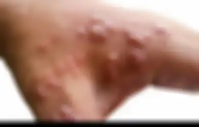 Kenali Lebih Jauh Cacar Monyet, Penyakit Zoonosis yang Kasusnya Didominasi oleh Pria yang Berhubungan Badan dengan Pria, Ini Gejala yang Timbul dan Cara Mencegahnya