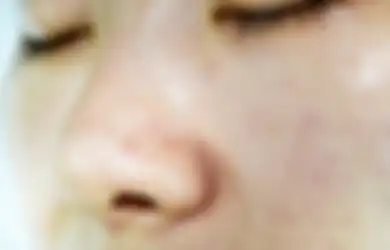 Wajib Tahu, Begini 6 Cara Menghilangkan Komedo Putih di Hidung, Simak
