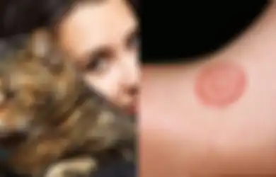 Tips Hidup Terhindar dari Infeksi Ringworm, Penyakit yang Patut Diwaspadai Lantaran Dapat Ditularkan dari Kucing Kesayangan