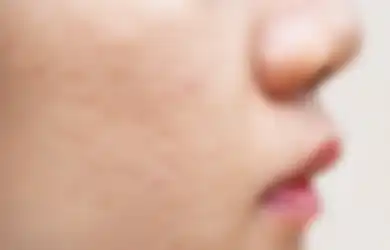 Gini 5 Cara Mengatasi Bopeng Jerawat Tanpa Perlu ke Dokter Kulit
