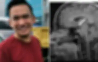 Mengenal Lebih Jauh Empty Sella Syndrome, Penyakit Langka yang Diidap Ruben Onsu, Ini Gejala-gejala yang Umumnya Dirasakan