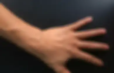 Pembuluh Darah Terlihat Jelas di Permukaan Kulit, Kenali 5 Penyebabnya