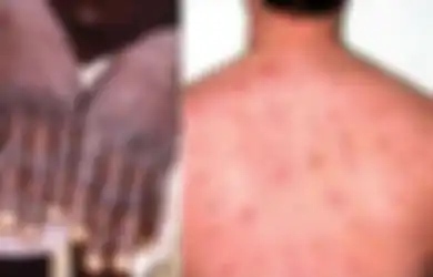 Healing Berujung Pening! Pria Ini Derita Cacar Monyet, HIV dan Covid-19 Sepulang Liburan dari Spanyol, Akui Sempat Berhubungan Sesama Jenis dengan Cara Ini