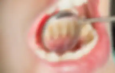 Aneka Tips Kesehatan, Karang Gigi Rontok Cuma Pakai Bahan Alami, Dijamin Makin Percaya Diri dengan Gigi Bersih Berkilau