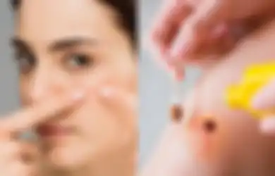 Bikin Geger Dunia Maya, Selebgram Ini Atasi Jerawat Pakai Obat Merah, Benarkah Ampuh? Begini Penjelasan Mengejutkan dari Ahli!