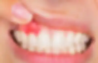 Tips Hidup Bebas Sariawan, Kenali 4 Hal Umum yang Jadi Penyebabnya Ini, Salah Satunya Gegara Makan Pedas