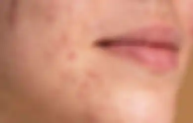 Gak Pakai Skincare Mahal, Inilah 5 Masker Alami yang Ampuh Atasi Jerawat