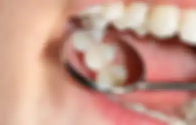 Tips Hidup Bebas Gigi Berlubang, Kenali Deretan Penyebab hingga Cara Mengatasinya Berikut Ini