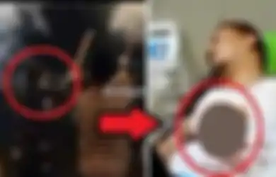 Tidak Diamputasi, Begini Kondisi Jari Wabup Kaur Bengkulu yang Terkena Ledakan Kembang Api di Malam Tahun Baru