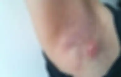 Cegah Jerawat Tumbuh di Ketiak, Harus Terapkan 6 Hal Penting Ini!