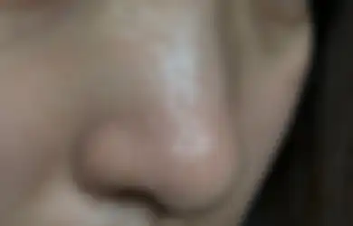Lakukan 5 Perawatan Ini Untuk Mengatasi Pori-Pori Hidung yang Besar