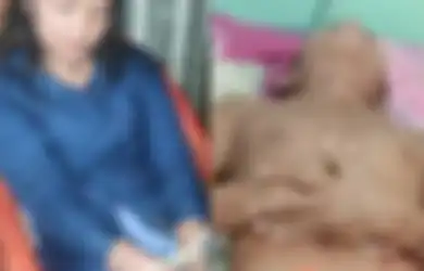 Dipotong Sampai Nyaris Putus Pakai Keris, Alat Vital Pria di Sibolga Akhirnya Bisa Disambung Lagi, Begini Nasib Pacarnya Sekarang