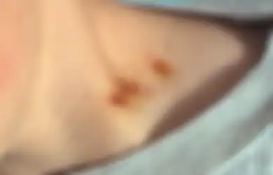 Temukan Bekas Cupang di Leher, Ibu Syok Anak Gadisnya Sudah Tak Perawan dan Kerap Bercinta dengan Banyak Pria