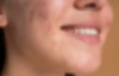 Gak Pakai Skincare Mahal! Cara Mengatasi Jerawat Ini Cuma Pakai Madu loh, Begini Caranya!