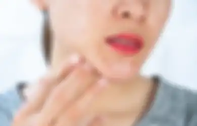 Harus Tahu, Inilah 4 Makanan yang Bisa Menyebabkan Jerawat Diwajah