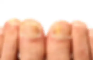 Selain karena Kena Kunyit, Ini 5 Penyebab Kuku Kuning. Diabetes?