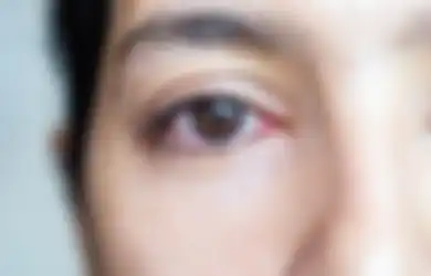 Selain Debu, Ini 4 Hal Penyebab Mata Berair. Apakah Berbahaya?