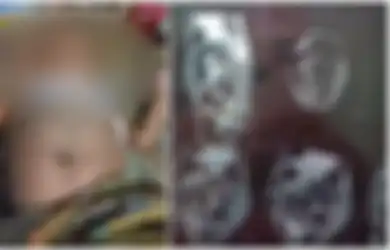 Bayi dengan Perut Membuncit Dikira Hamil, Dokter Bongkar Fakta Penyakit yang Diderita hingga Harus Segera Dioperasi