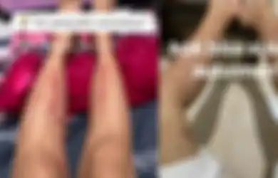 Viral di TikTok Wanita 25 Tahun Idap Autoimun hingga Muncul Bintik Merah di Kaki, Penyebabnya Gara-gara Suka Jajan