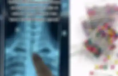 Hasil Rontgennya Bikin Ngilu, Wanita di Jombang Harus Dioperasi Gara-gara Telan Jarum Pentul, Netizen: Aduh Ngeri