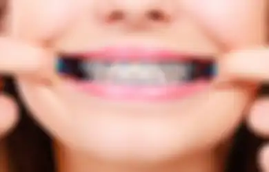 5 Cara Mengatasi Sakit Gigi Akibat Pasang Behel. Biar Nyaman!