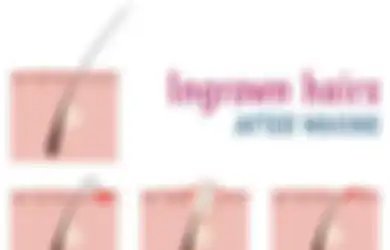 Ini Penyebab Ingrown Hair Alias Benjolan di Area Vagina, Perhatikan