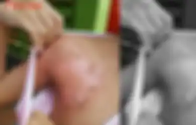 Kulit Gadis Cantik Ini Melepuh Usai Mandi di Sebuah Resort hingga Divonis Alami Hal Ini, Kondisinya Bikin Nangis!