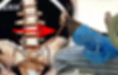 Dokter Syok Temukan Hewan Panjang Berbentuk Aneh di Perut Pasien Usai Operasi, Diduga Ini Penyebabnya