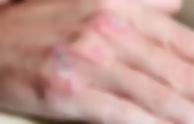 Eksim Itu Bukan Penyakit Gatal Karena Jamur, Bro. Ini 5 Hal Yang Perlu Kamu Ketahui 